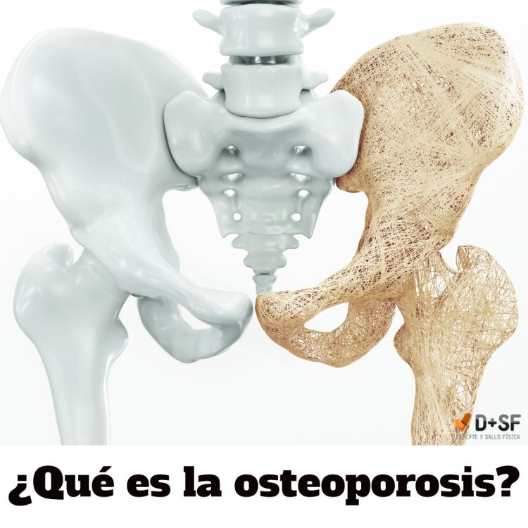 cómo prevenir la osteoporosis